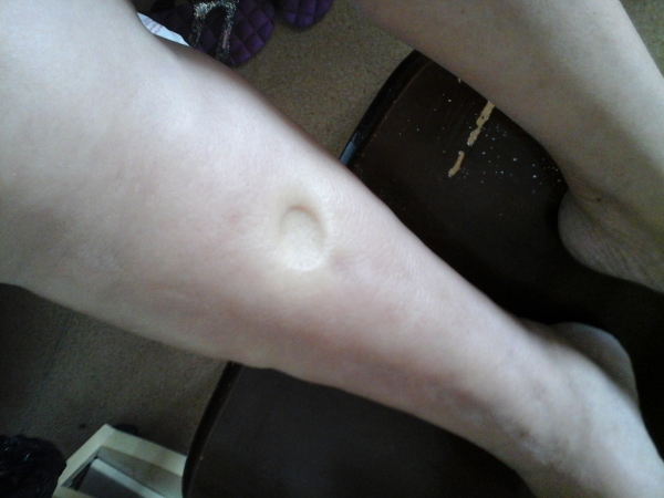 错失治疗肾病最佳时机，拖成肾衰竭！来自一个中年教师的悔恨！