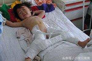 《小儿夹腿综合征》爸爸妈妈注意了！