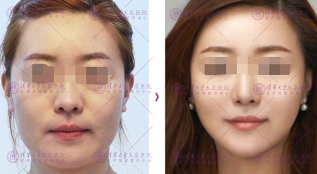 超声刀和热玛吉区别合适人群,热玛吉和超声刀该怎么选