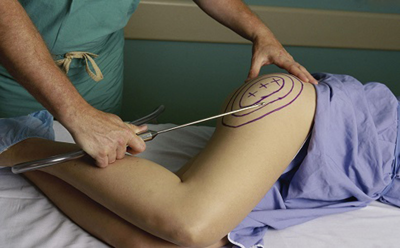 最先进的吸脂减肥,神乎其神减肥告捷案例