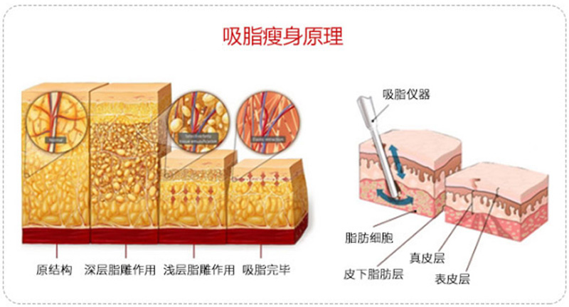 最先进的吸脂减肥,神乎其神减肥告捷案例