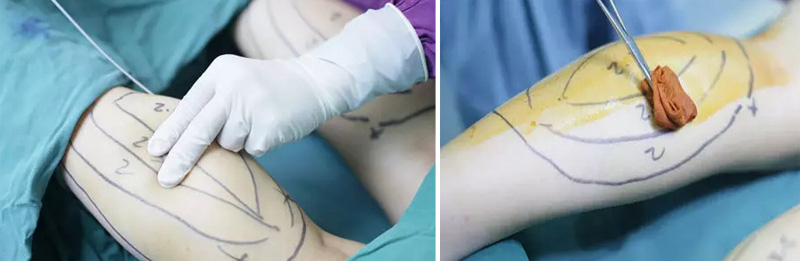 最先进的吸脂减肥,神乎其神减肥告捷案例