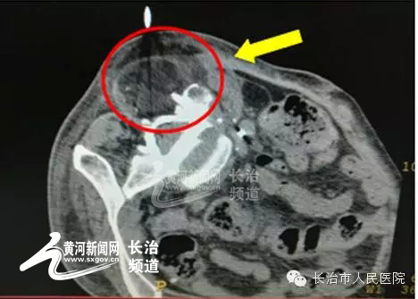 冷冻消融治疗肿瘤挂什么科,肿瘤氩氦刀冷冻治疗