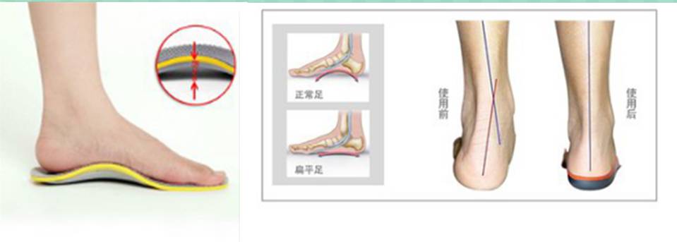 如何让扁平足拥有足弓,扁平足跑起来有足弓