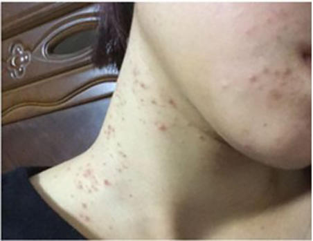 痘痘爆发的10大影响因素,痘痘一直不好因为做错了这几件事