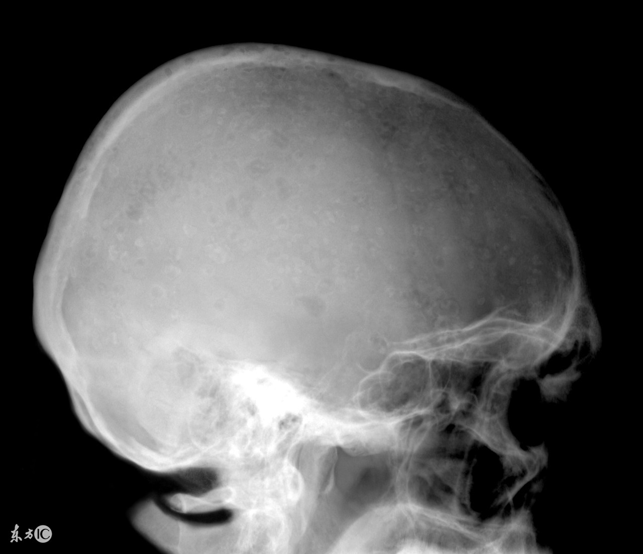 多发性骨髓瘤自体移植要多少钱,多发性骨髓瘤报销后每个月花费