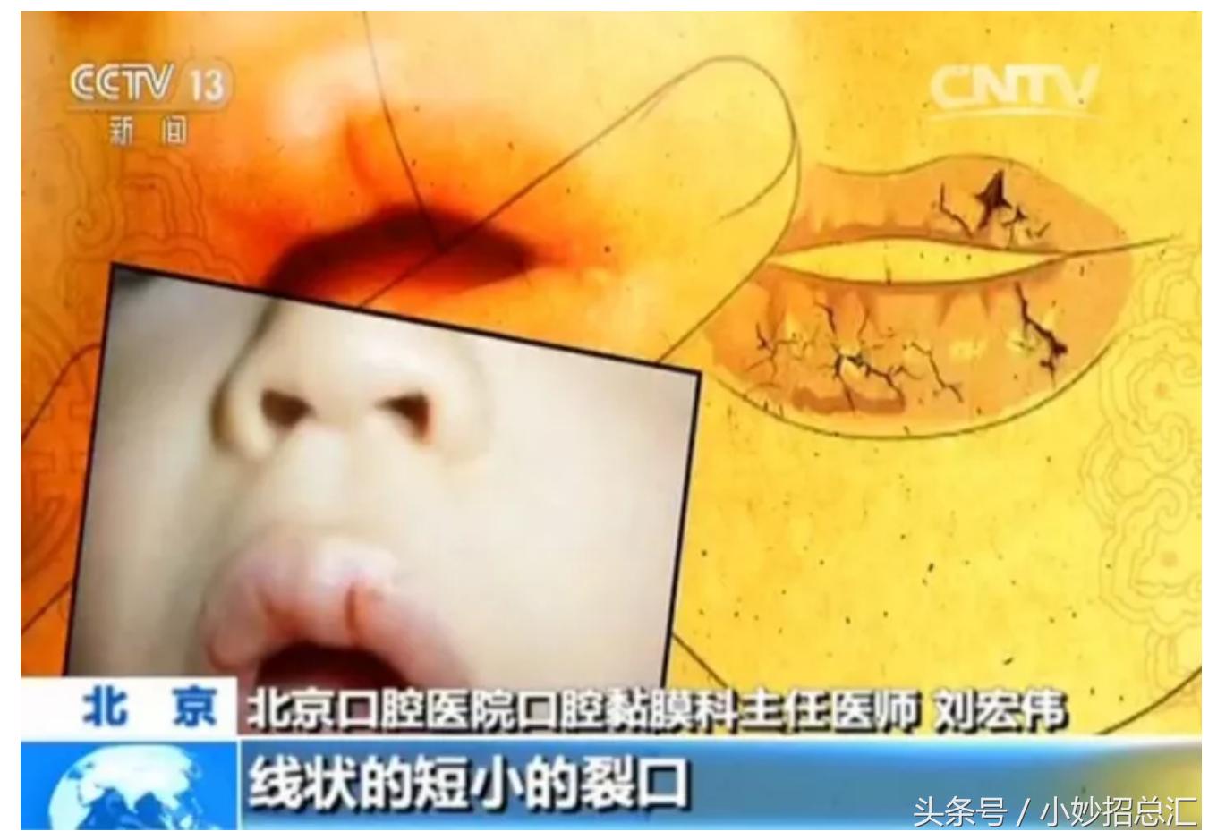 秋冬唇怎么护理,换季唇的正确护理方法