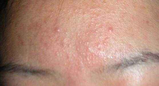 额头反复长痘的原因及解决方法,额头长痘的原因和解决方法