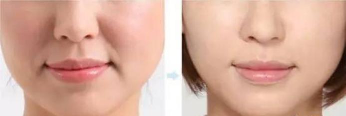 法令纹深用埋线好还是超声刀好,超声刀去除法令纹多少钱