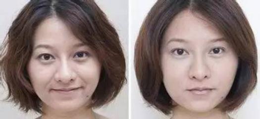 法令纹深用埋线好还是超声刀好,超声刀去除法令纹多少钱