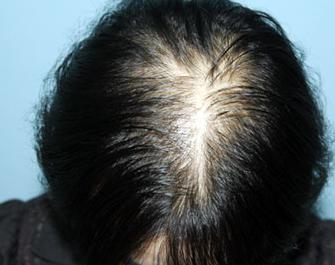 脂溢性脱发遗传性脱发植发有用吗,植发是不是治疗脱发最好的方法