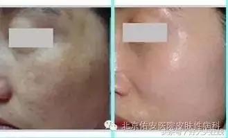 褐斑的最佳治疗方法,褐青斑最佳的治疗方法