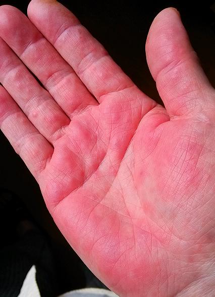 中美联手告捷案例,双安联合治疗肝癌