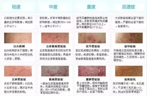 黑头痘痘粉刺去除过程护理,巨大粉刺型痘痘怎么治疗