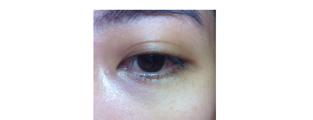 女大学生泪沟黑眼圈用什么眼霜,眼霜能去脂肪粒吗