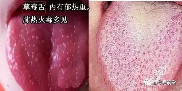 中医小儿舌诊辨证图谱,小儿舌诊辨证图谱课件