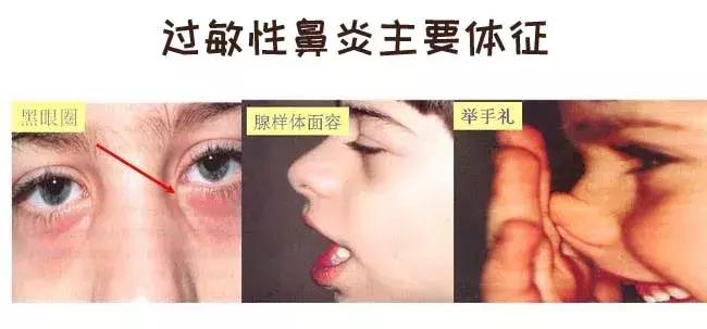 鼻炎漫画视频,过敏性鼻炎科普小视频漫画