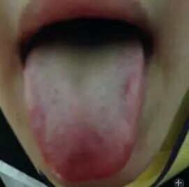 中医小儿舌诊辨证图谱,小儿舌诊辨证图谱课件