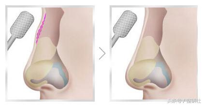 甜美少女养成计——俊翘美鼻