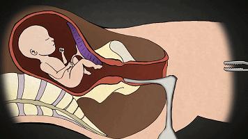 流产和宫外孕哪个可怕,流产跟怀孕有什么关系