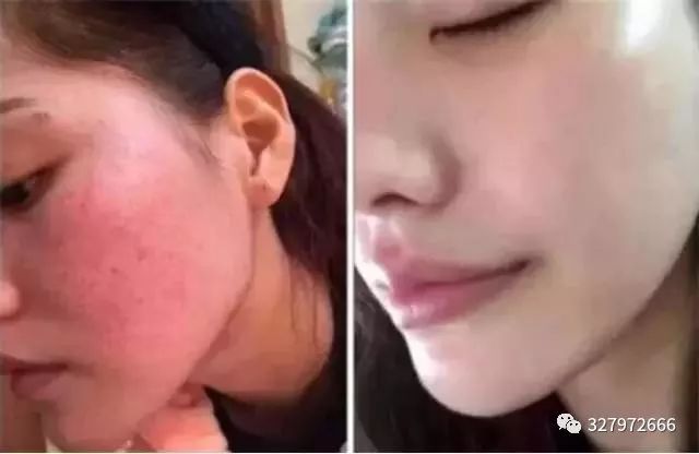 朵嘉浓修复激素脸案例,朵嘉浓治激素脸多长时间能稳定