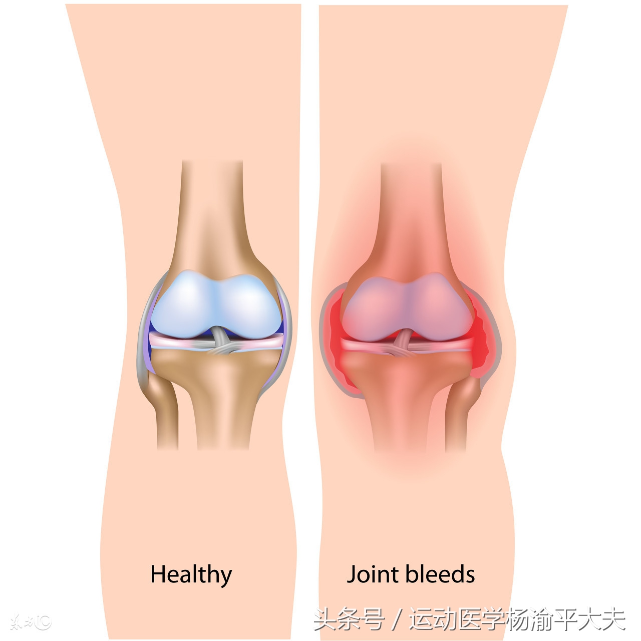 什么情况属于滑膜炎,滑膜炎的概念是什么