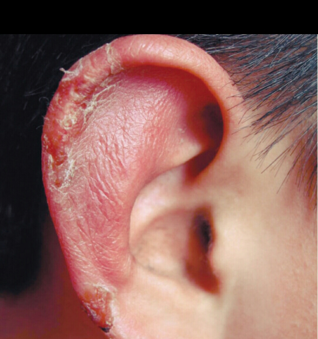 冻伤疮什么意思,冻疮的治疗方法