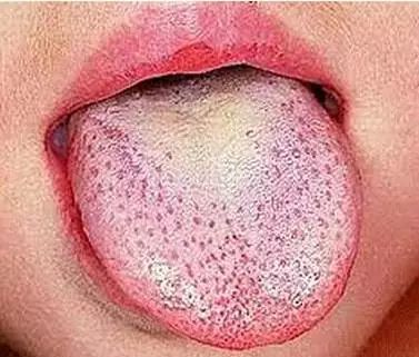 家长要小心！这种病广东进入流行高峰期，香港已拉响警报！