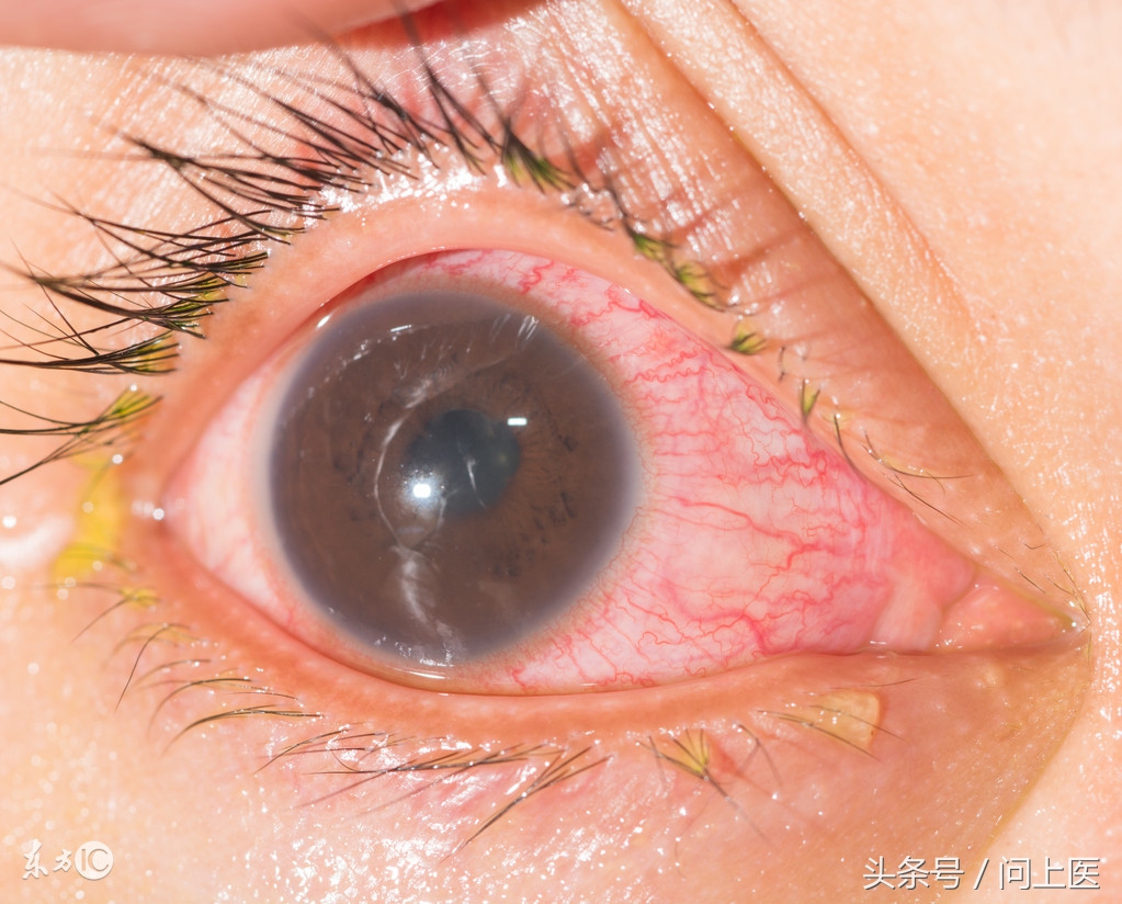 类风湿关节炎累及眼睛怎么治疗,类风湿性关节炎与眼部的并发症