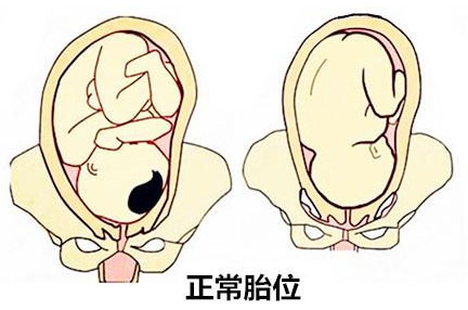 产妇胎位不正医生纠正难产完全版,孕妇胎位不正什么原因导致的