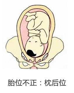 产妇胎位不正医生纠正难产完全版,孕妇胎位不正什么原因导致的