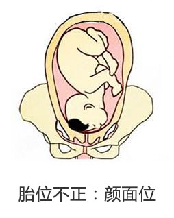 产妇胎位不正医生纠正难产完全版,孕妇胎位不正什么原因导致的