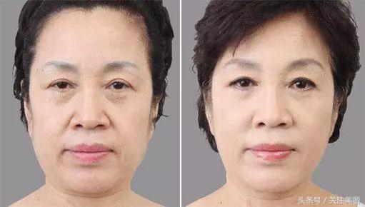 打完瘦脸针多久能够吃阿莫西林,打完除皱瘦脸针多久能洗脸敷面膜