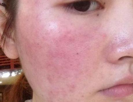 激素脸面部发红怎么修复,激素脸泛红怎么样能恢复正常