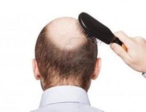 脱发真的是绝症吗,脱发除了植发之外有什么办法