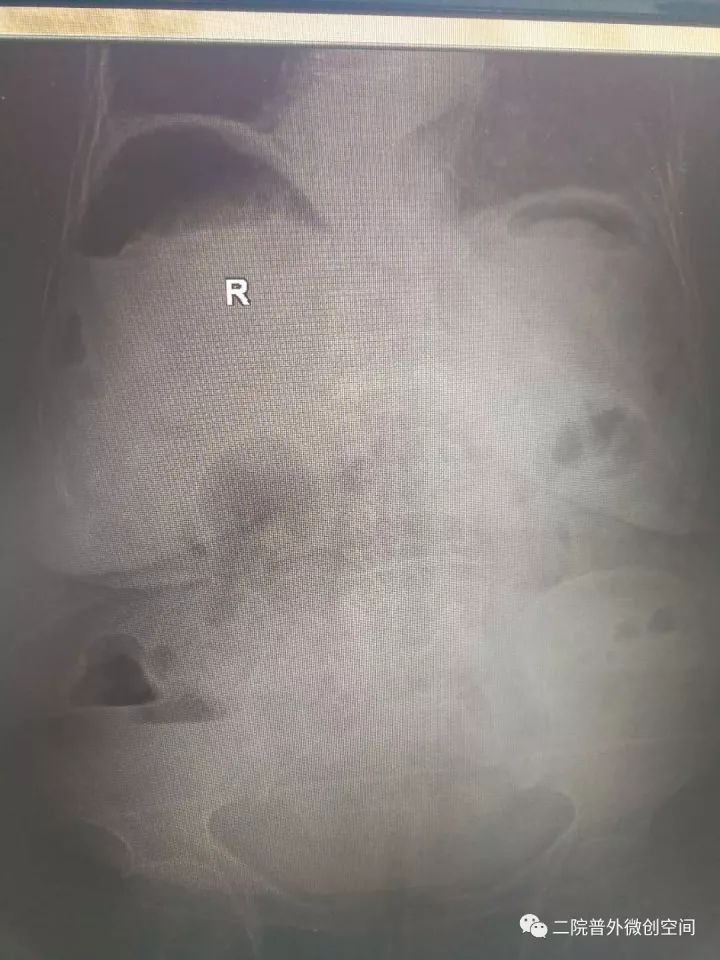 「病人故事」耄耋胃穿孔老人经微创手术治疗后今天痊愈出院啦！这个疾病很凶险，常吃止痛药的朋友要注意哦！