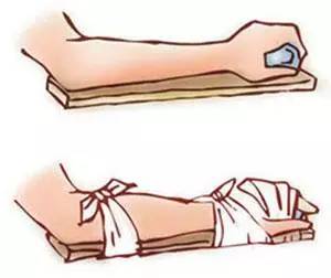 骨折卧床休息怎么个姿势,骨折了不能下地吗