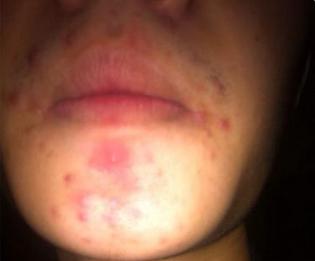 背后每年秋冬长痘怎么治,经常长痘的肤质怎样避免长痘