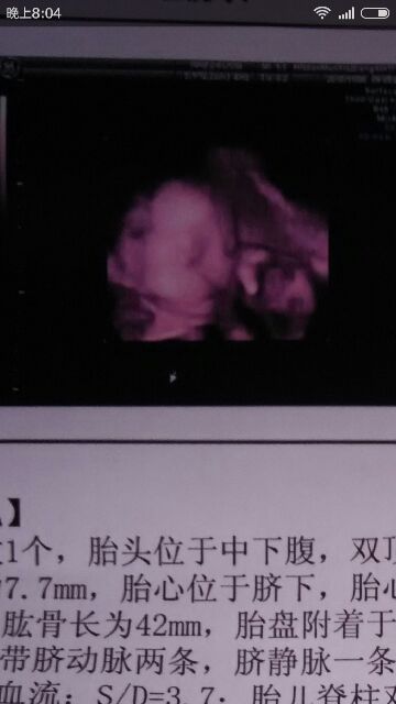 宝妈分享怀宝宝的症状,怀了女宝初期感受