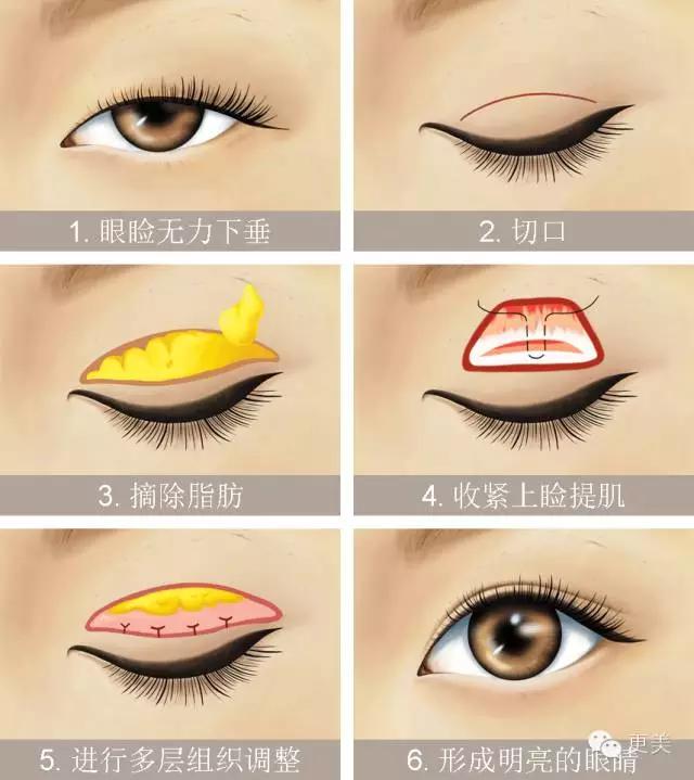 抬头纹手术会不会影响眼睛,抬头纹手术后有后遗症吗