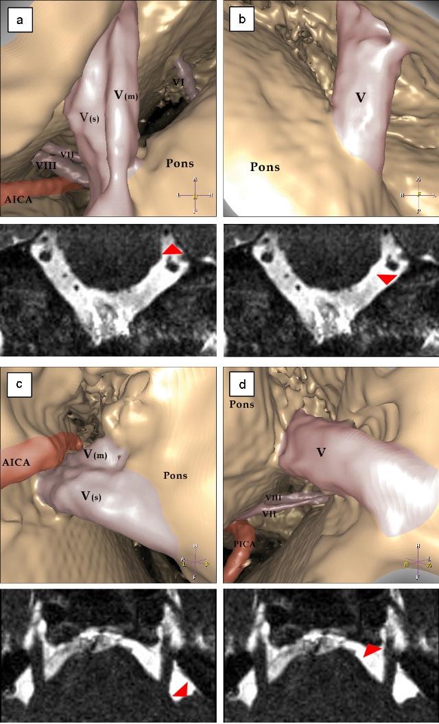 三叉神经痛和继发性的三叉神经痛,三叉神经贴治疗三叉神经痛的原理