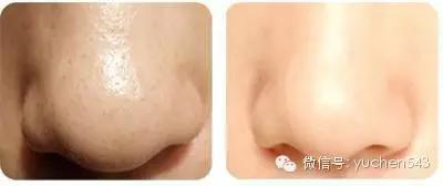 这个妈妈是这样用五毛钱的苏打去黑头的，膜拜！