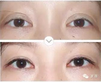 抬头纹手术会不会影响眼睛,抬头纹手术后有后遗症吗