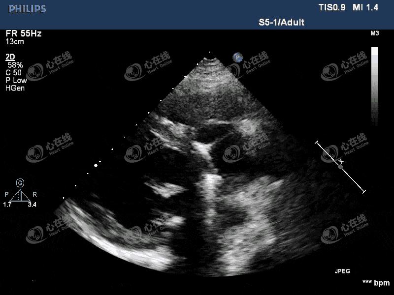 「“医”站到底」26：主动脉瓣机械瓣置换术后发热，您答对了吗？