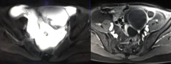 女性下腹疼痛是什么病,女性下腹疼痛的预兆