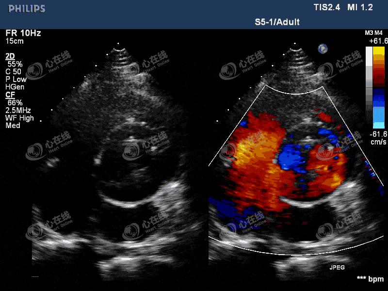 「“医”站到底」26：主动脉瓣机械瓣置换术后发热，您答对了吗？