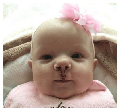 怀孕5个月了查出宝宝兔唇,孕妈没有按时产检娃有兔唇