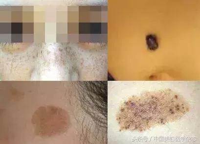 调Q激光能治疗鲜红斑痣吗,染料激光治疗色素增加性皮肤病