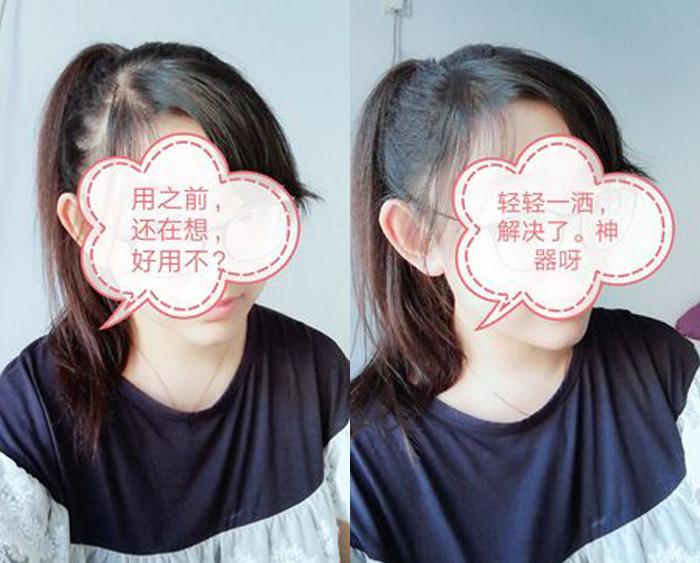 掉头发是什么原因引起的脱发,额头脱发的原因和治疗方法