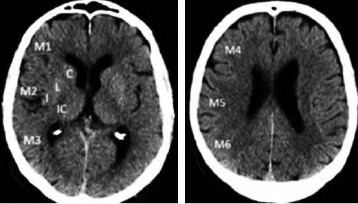 2017急性缺血性卒中血管内治疗影像评估中国行家共识